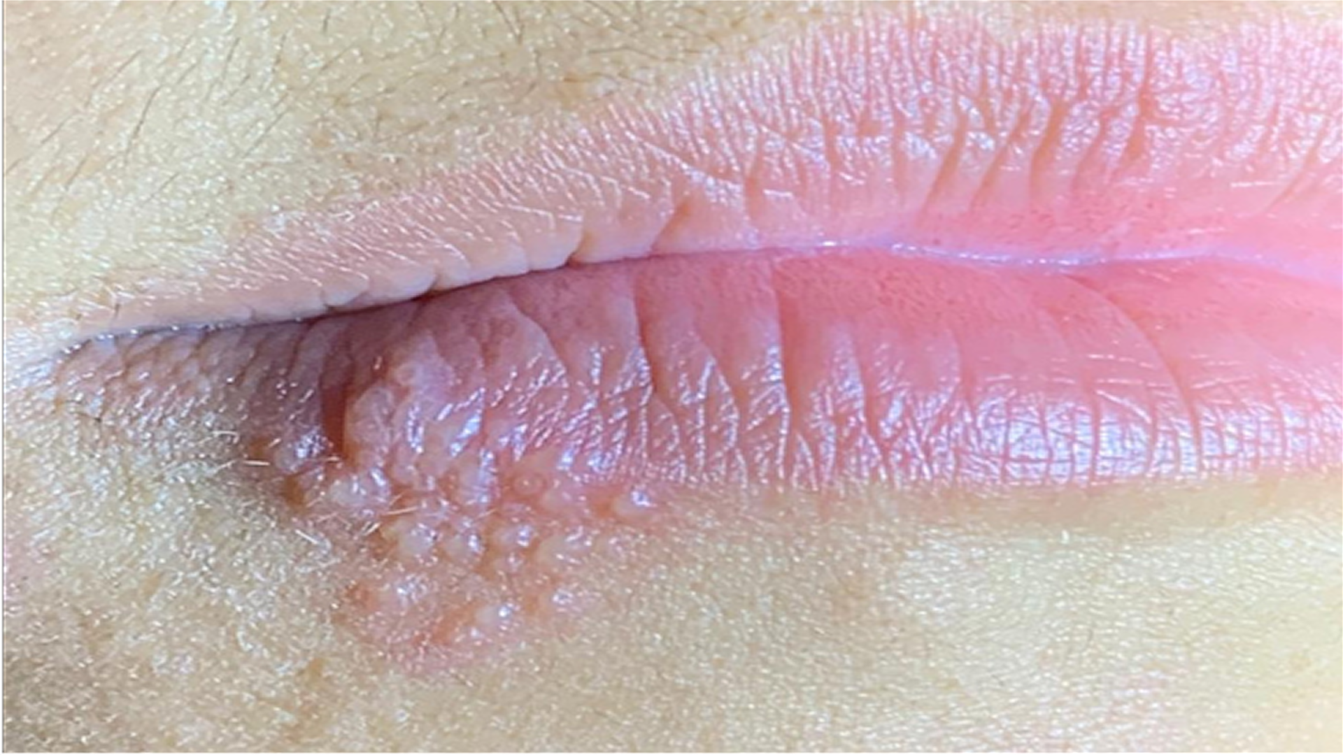 Herpes bucal: o que é, sintomas, crises e quando procurar um estomatologista