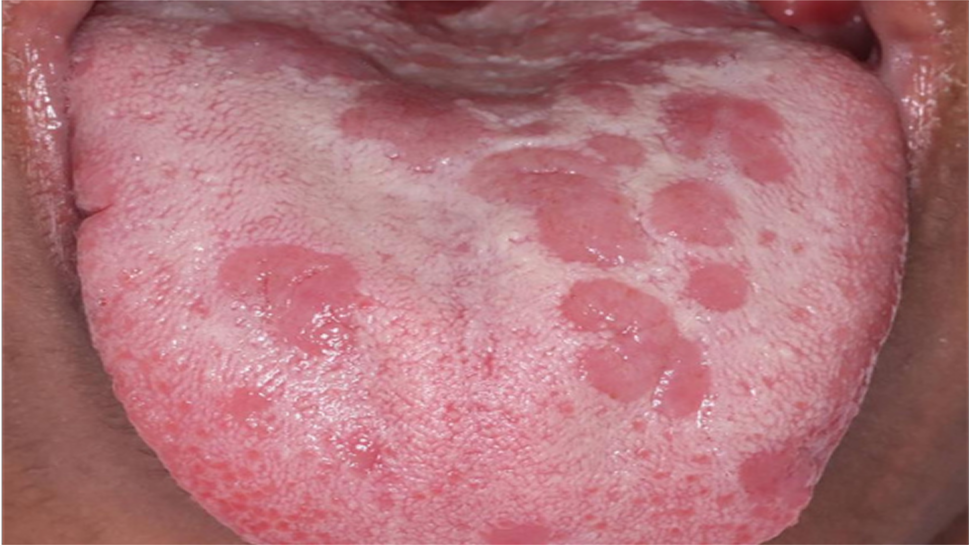 Sífilis na boca: sinais, sintomas e importância do diagnóstico precoce