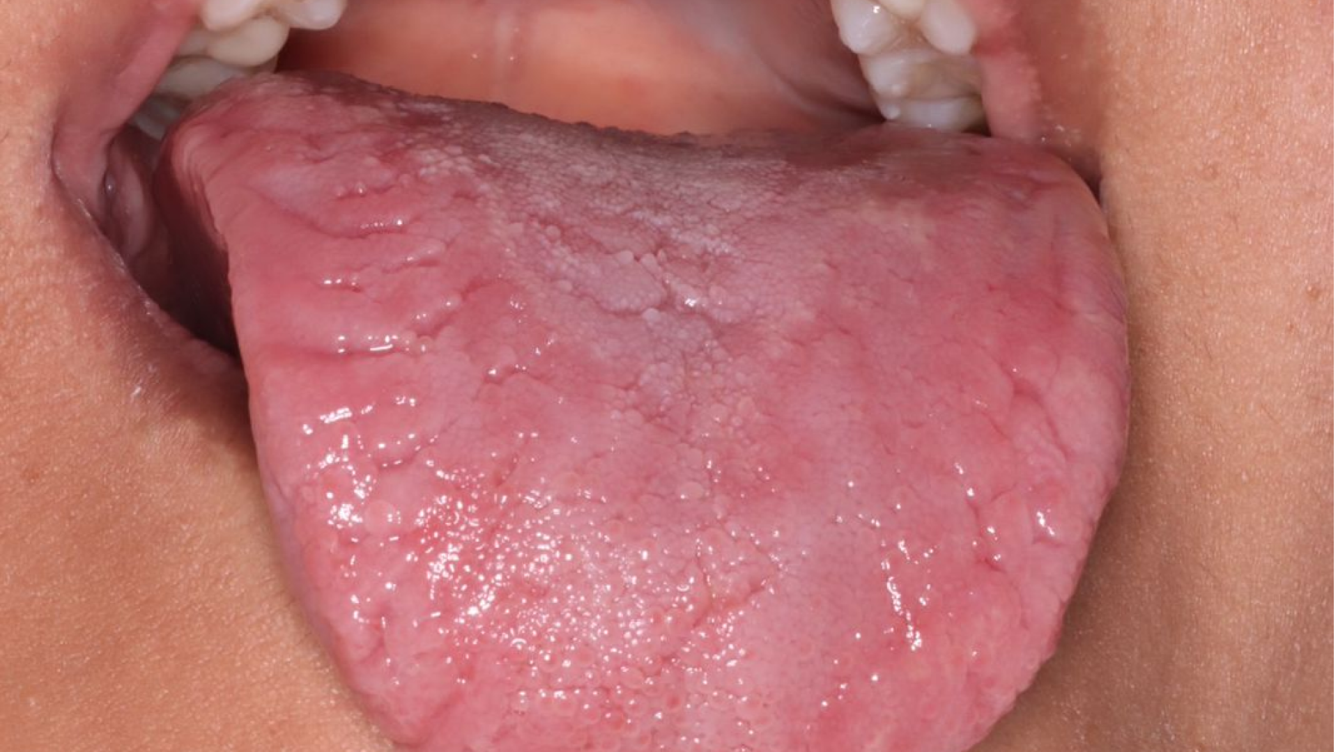 Língua geográfica: o que é, sintomas e quando precisa de tratamento