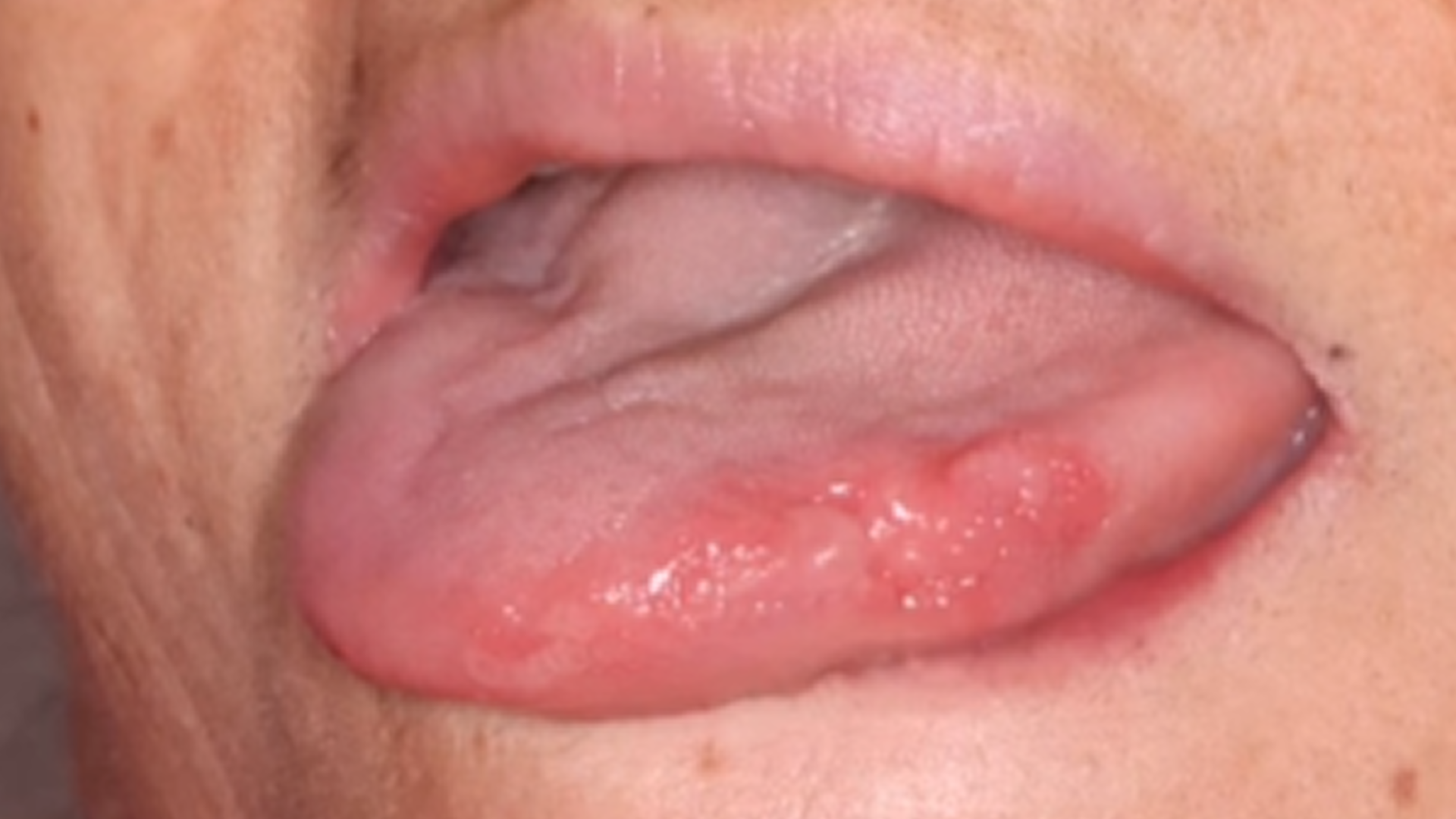 Câncer de boca: sinais de alerta, fatores de risco e diagnóstico precoce